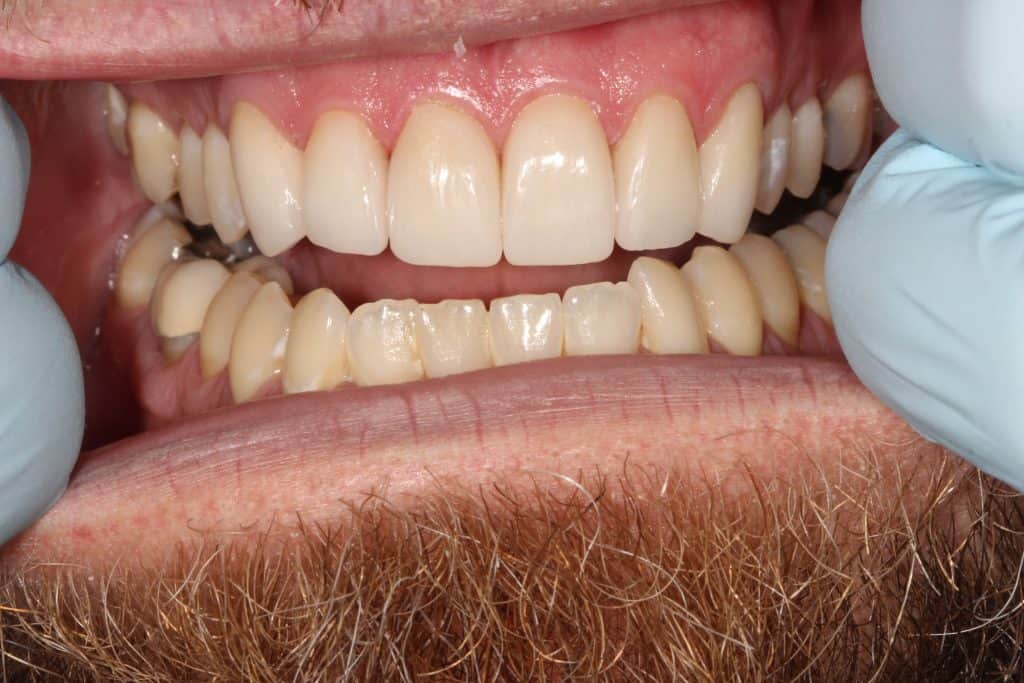 Crowns After